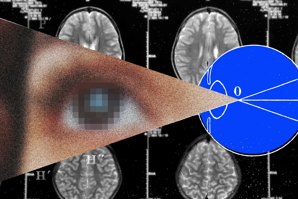 Restoring Vision: Electronic Retinal Implants