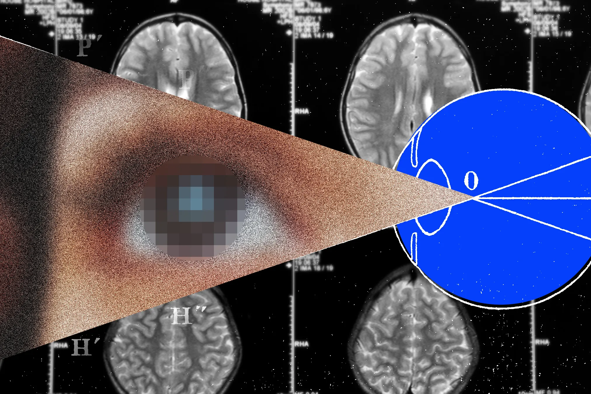 Restoring Vision: Electronic Retinal Implants